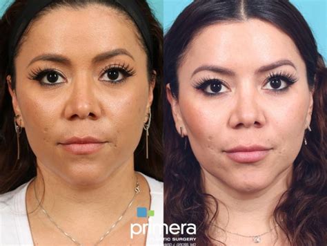 buccal fat removal pris|Buccal Fat Removal .